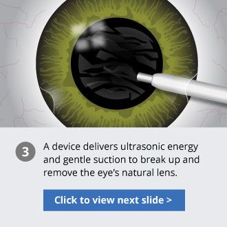 clear lens exchange process