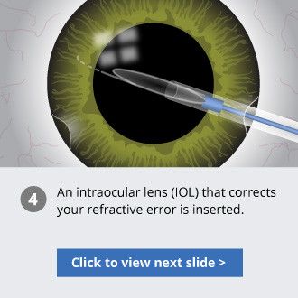 inserting an iol