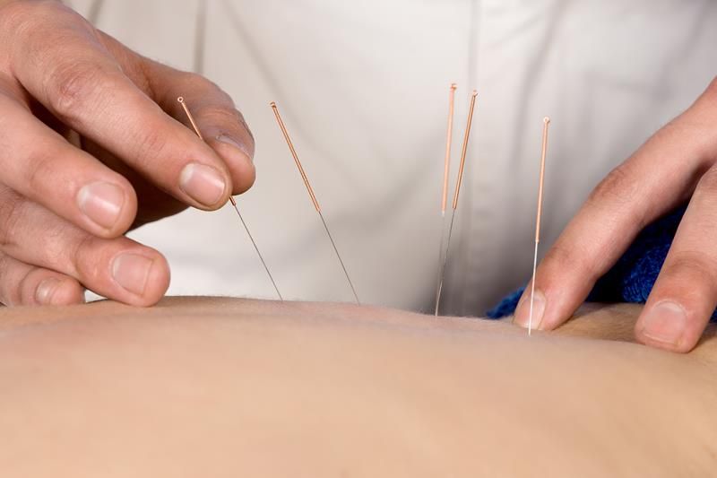 Acupuncture procedure 