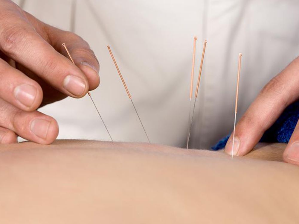 Acupuncture procedure