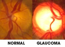 diagram of glaucoma