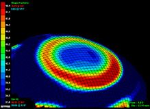 Corneal Topography