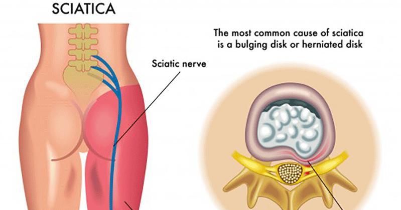 How to Get Relief From Sciatica