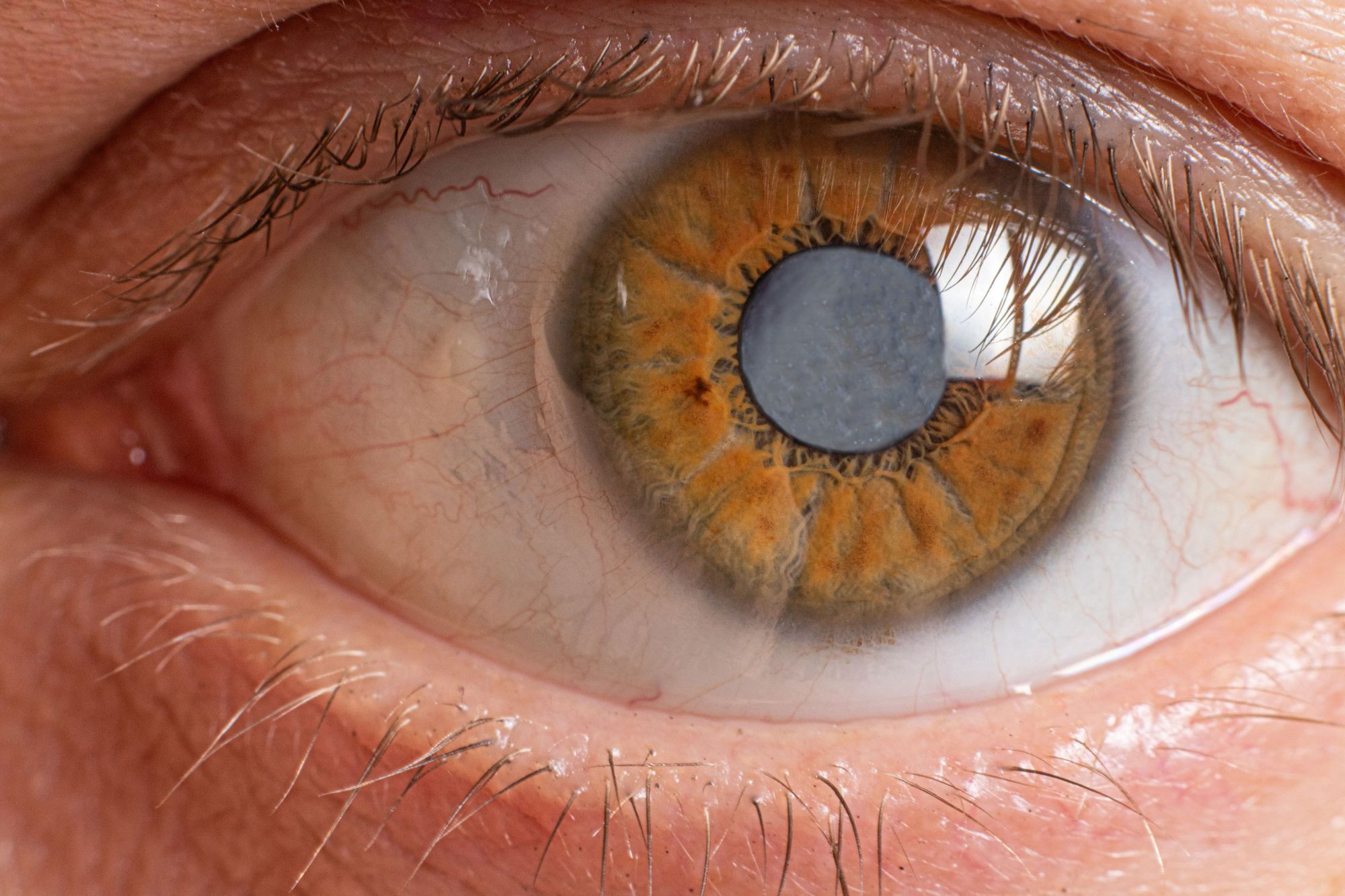 What Is The First Sign of Cataracts?