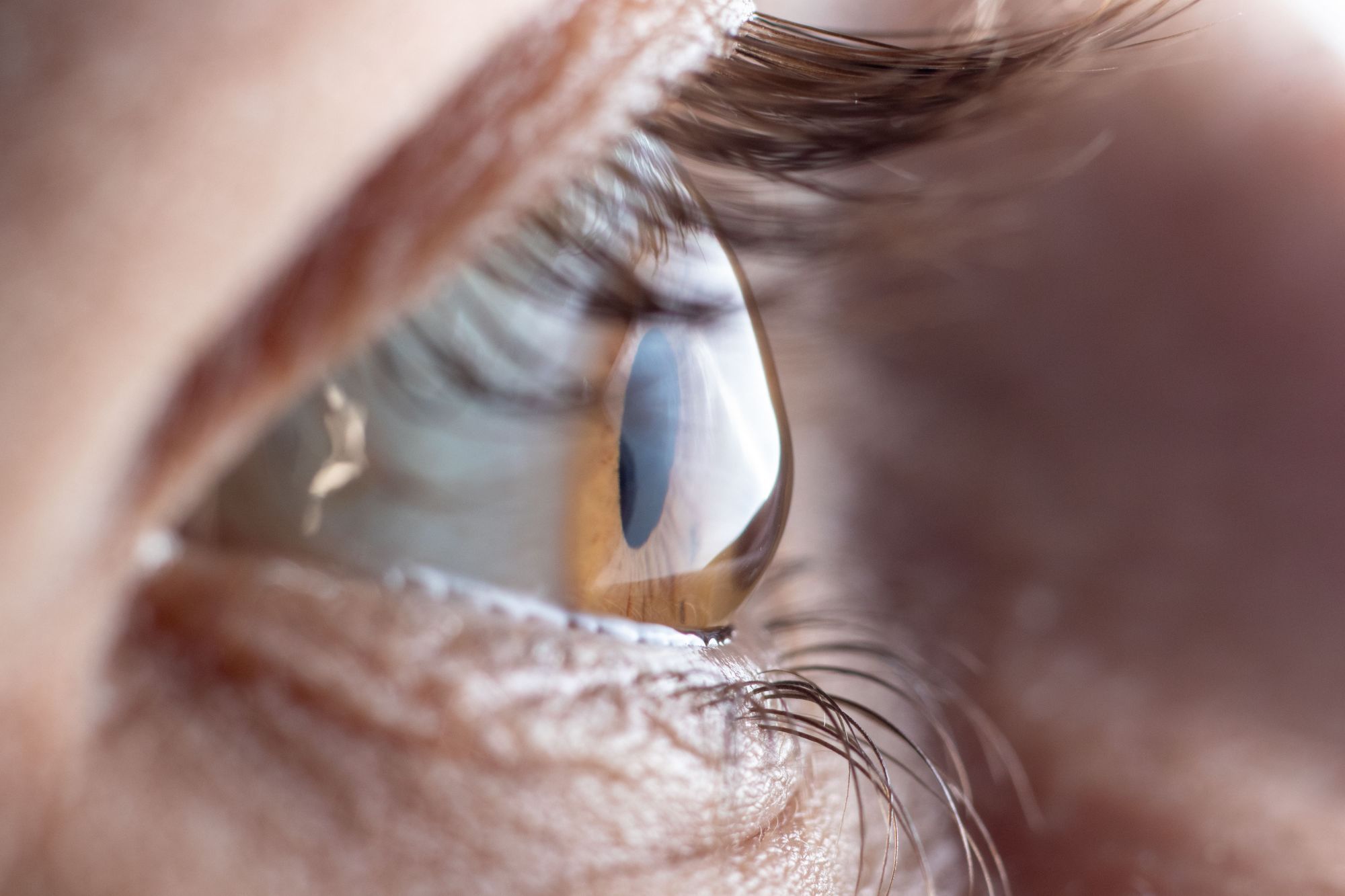 What Is Keratoconus and Corneal Disease?