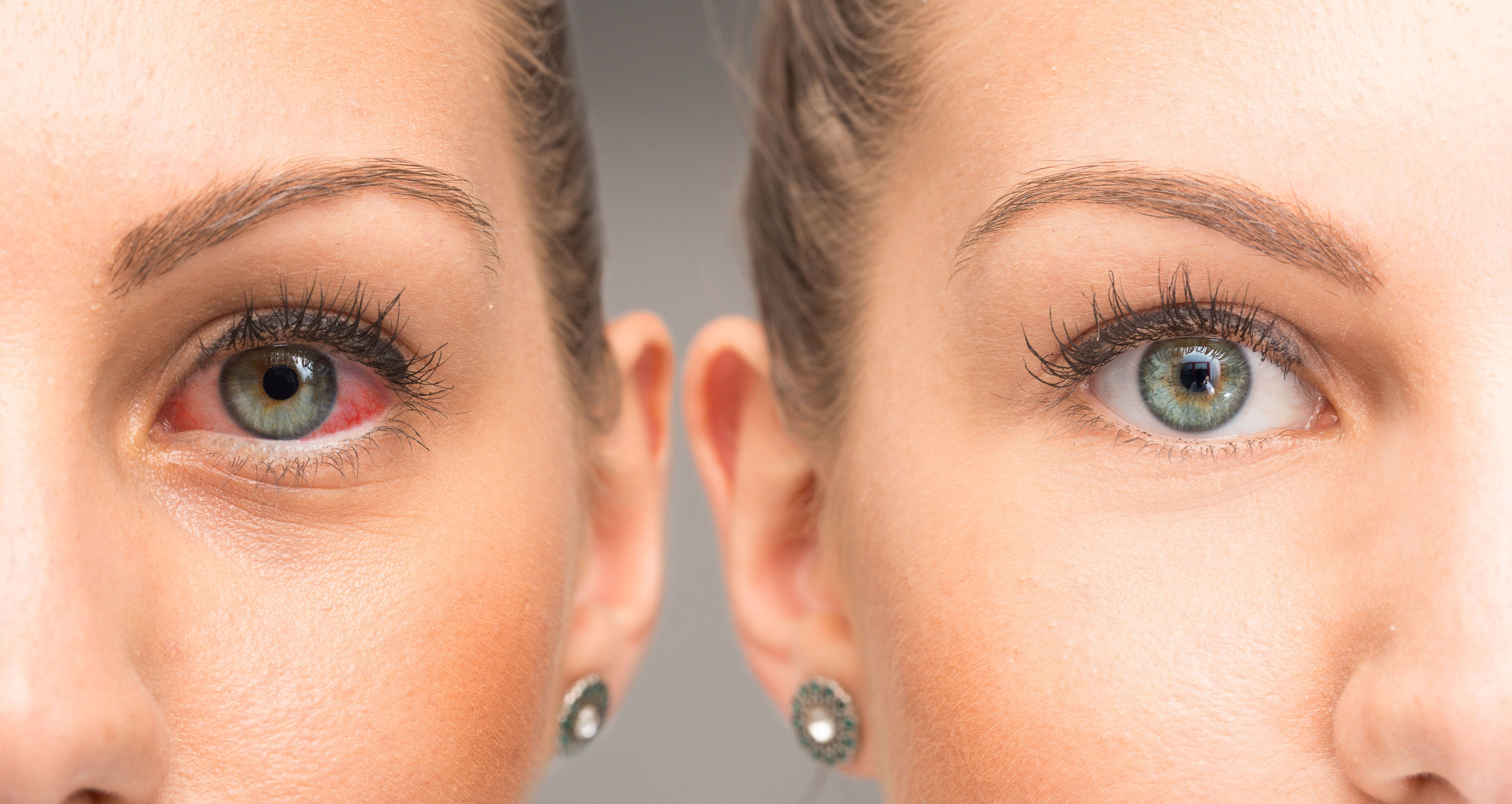 How Does LipiFlow® Treat Dry Eye?