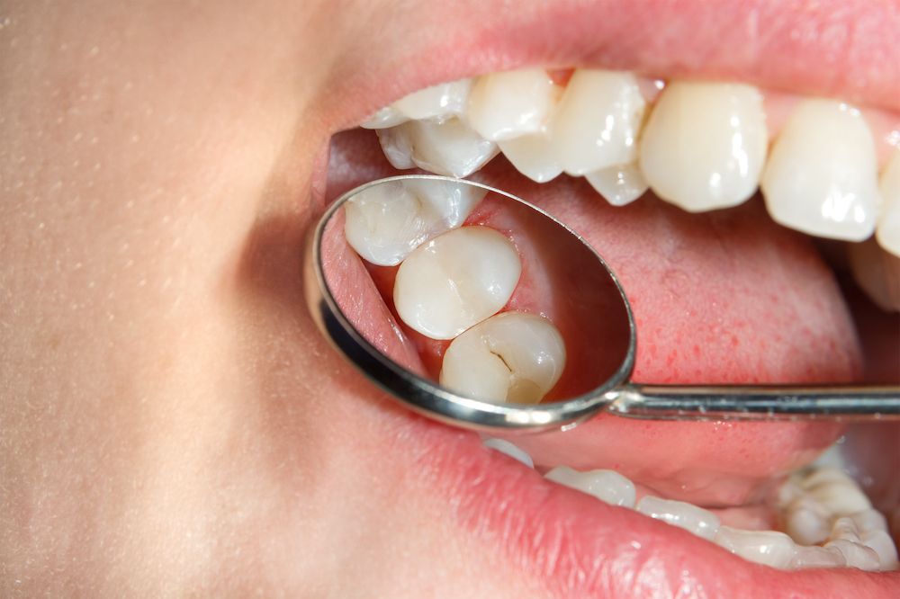 Purpose of Dental Sealants 
