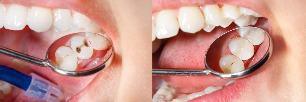 Amalgam vs. Composite Fillings