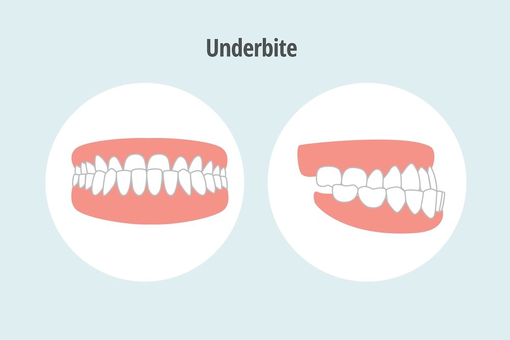 What Is an Underbite and What Causes It?