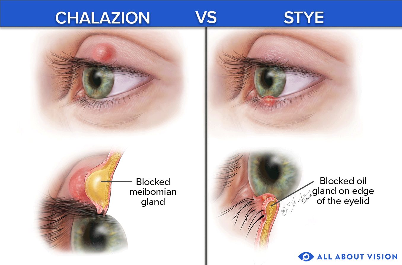 Chalazion vs Stye