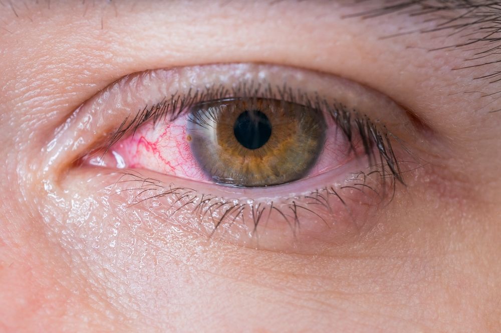 Eye Inflammation 101: What Triggers a Case of Pink Eye?