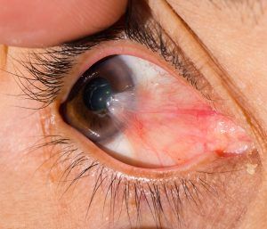 Specialty care of pterygium (surfer’s eye): How we Restore and Support Your Comfort, Clear Vision