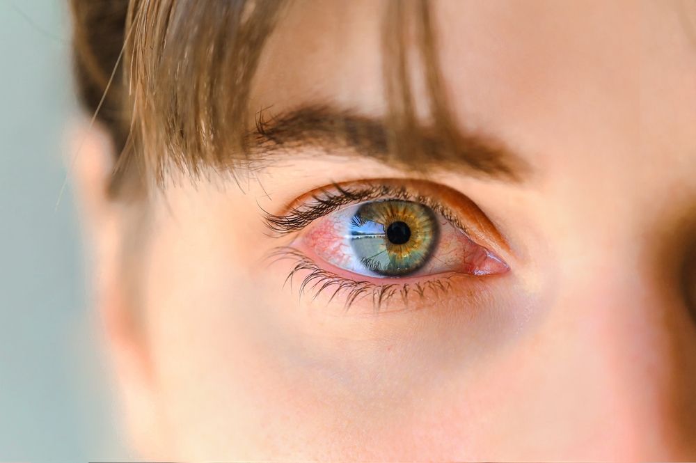Managing Pink Eye Discomfort: Soothing Your Itchy and Irritated Eyes
