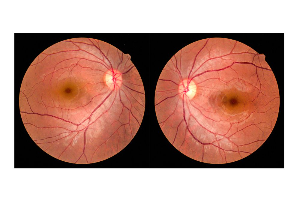 What is Optomap Retinal Imaging?
