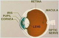 cataract