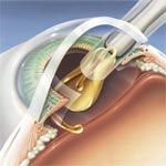 Insertion of lens implant into eye.