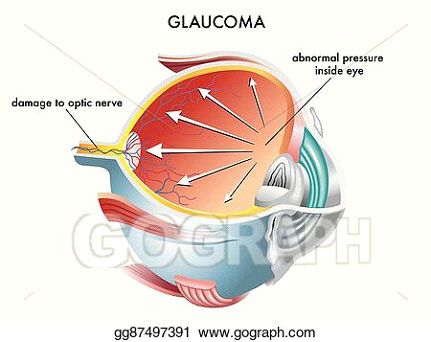 glaucoma