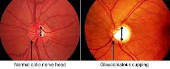 optic nerve