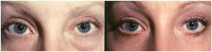 lower lid eye surgery