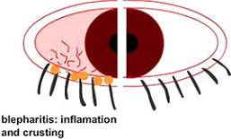 blepharitis