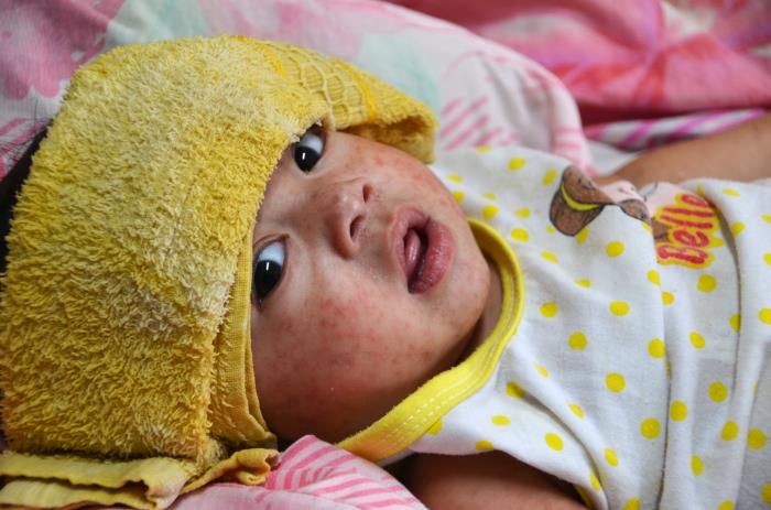 Measles progress in reverse as 22 mln miss vaccines