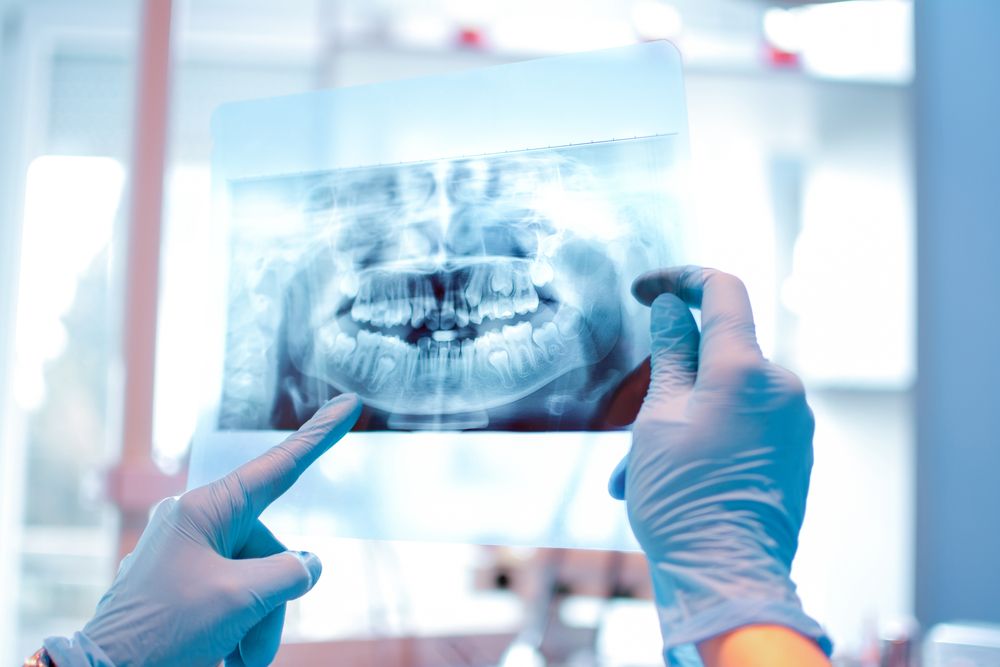What Can Dental X-Rays Reveal About Oral Health?