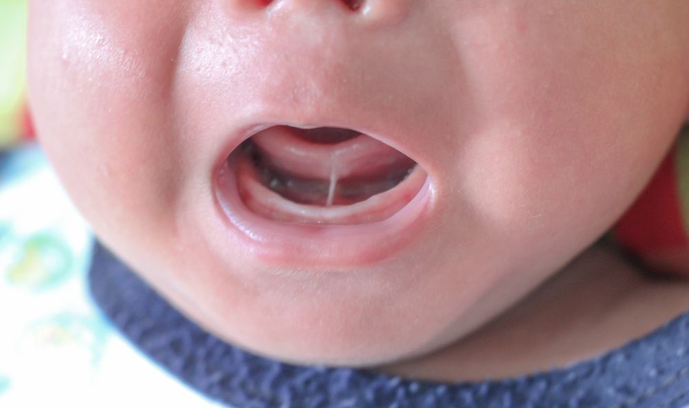 Signs Your Child Needs a Frenectomy