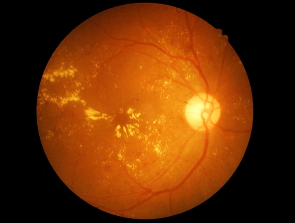 Preventing Macular Hole Progression: Tips for Eye Health and Risk Reduction