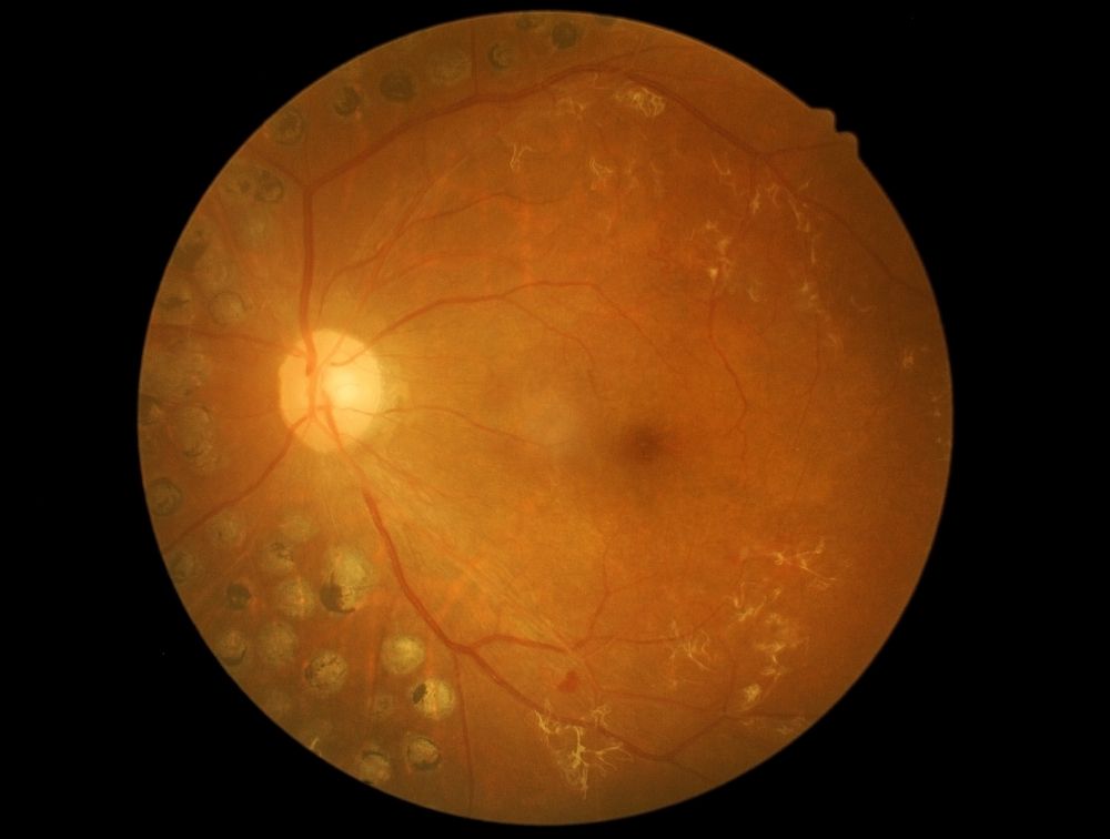 Diagnosis and Detection of Central Serous Retinopathy: How Eye Exams Can Help