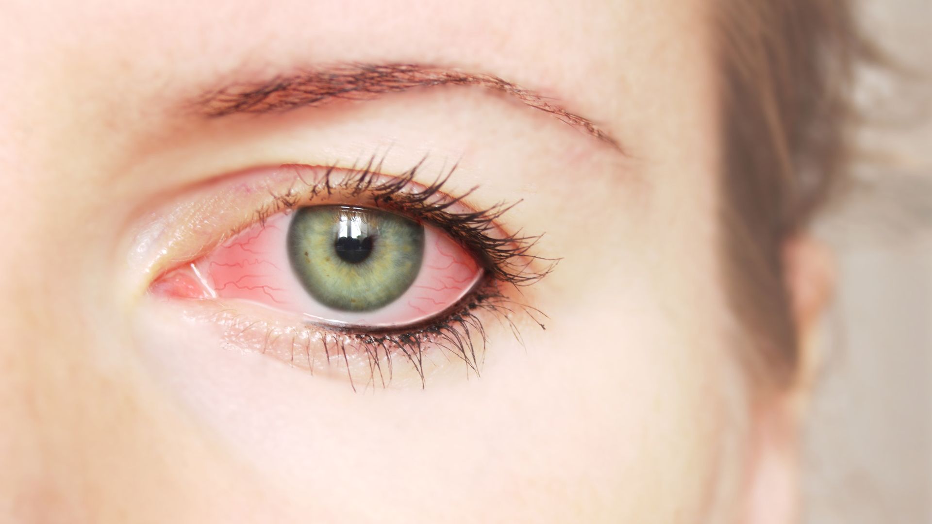 Bloodshot Eyes: Should you be concerned?