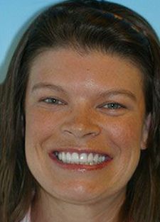 Woman smiling with new veneers