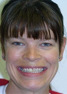 Woman smiling with discolored teeth