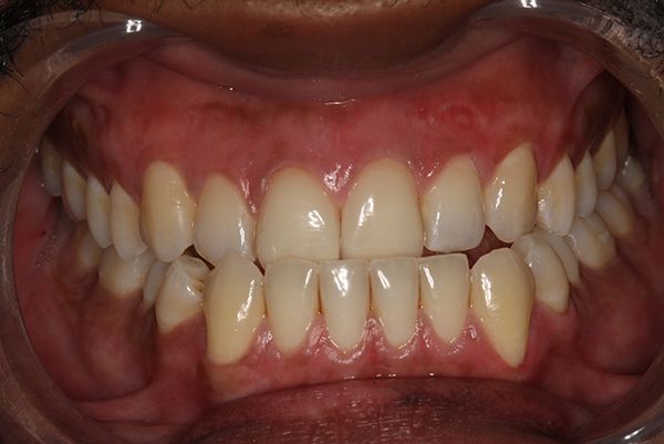 Close image of a person after lip depigmentation treatment