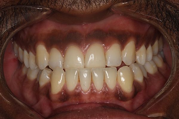 Close image of person with discoloration around teeth
