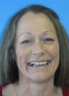Woman with an overbite and discolored teeth