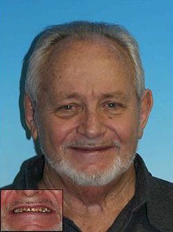 Man posing for the camera with many missing and discolored teeth