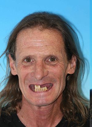 Man with missing top and bottom teeth smiling
