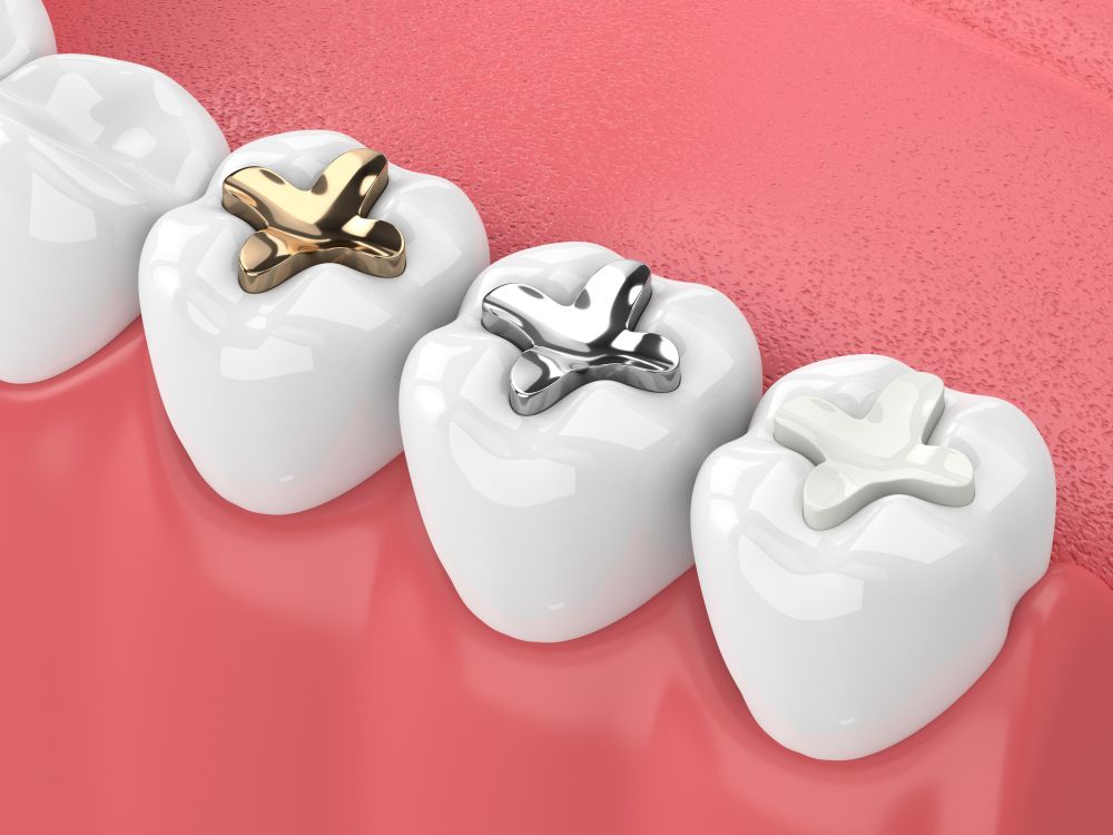 Tooth-Colored Fillings​​​​​​​