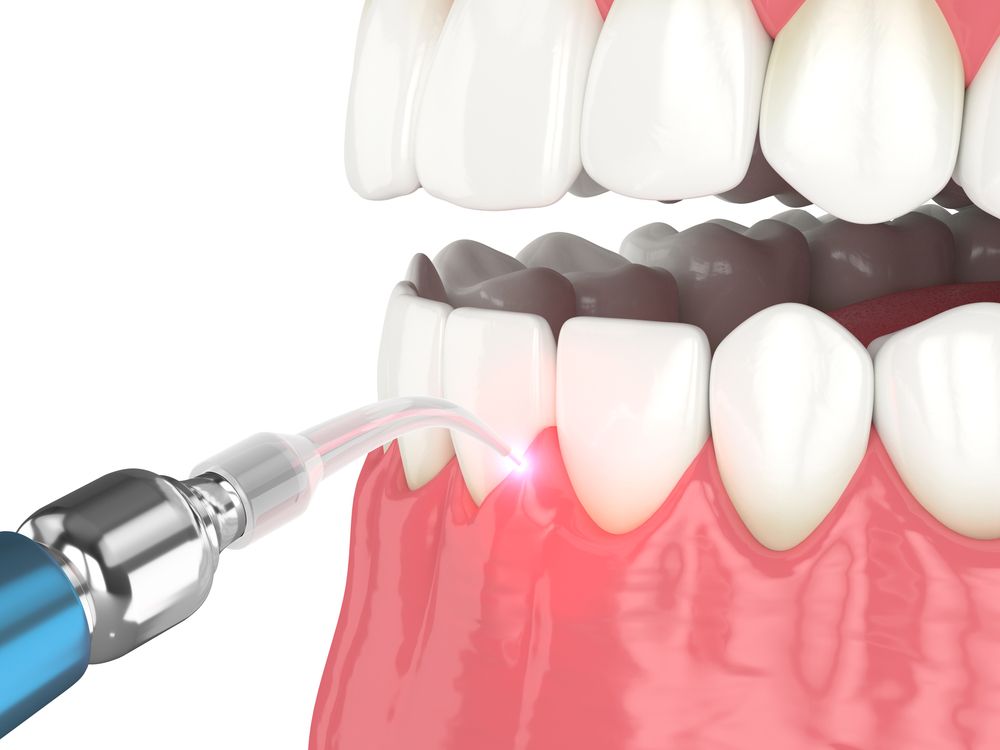 3d render of dental diode laser used to treat gums. The concept of using laser therapy in the treatment of gums​​​​​​​