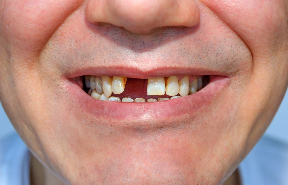 gentleman with a knocked-out tooth