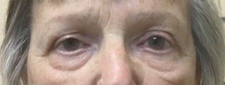 after eye treatment