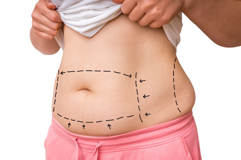 Who Is a Good Candidate for a Tummy Tuck?