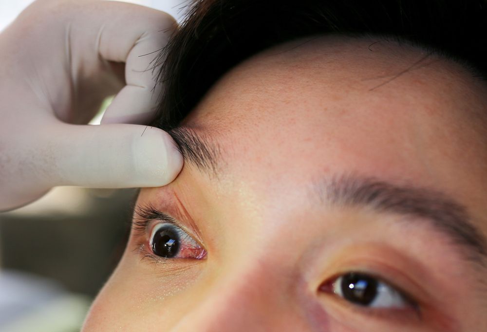 What to Do in an Eye Emergency