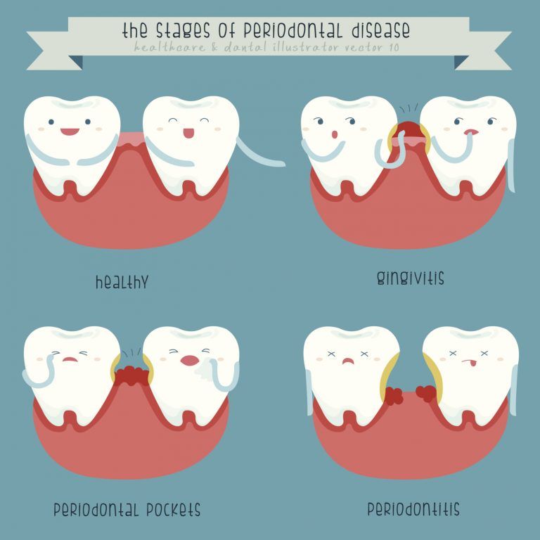 Do I Need a Periodontal Evaluation?