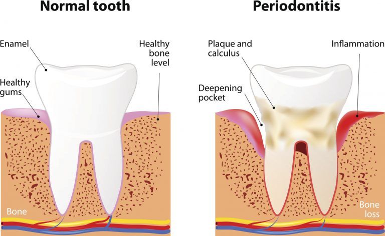 Half of American Adults Have Periodontal Disease: Are You One of Them? | Palm Beach Gardens Dentist