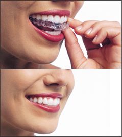 Straighten Your Teeth with Invisalign