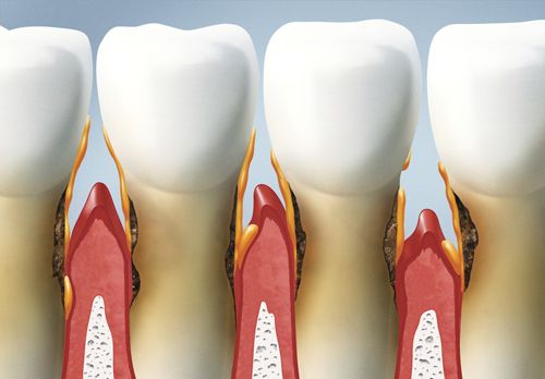 Your Gums Should Not Be Bleeding like That | Palm Beach Gardens Dentist