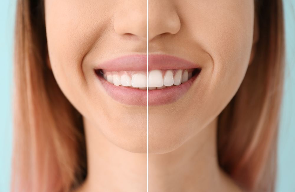 The Role of Periodontal Plastic Surgery in Cosmetic Dentistry