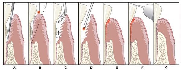 gum rejuvenation