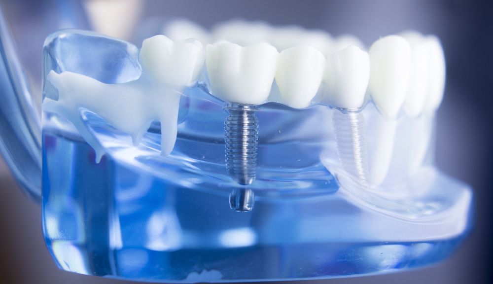 Do Dental Implants Improve Health?